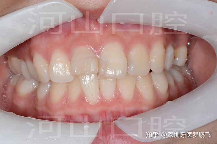 20岁牙齿能不能矫正_牙齿矫正能矫正过来吗_矫正牙齿可以动手术吗多少钱