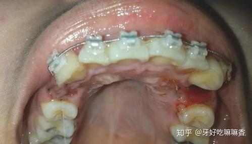 宁波青少年牙齿矫正_牙齿青少年矫正宁波哪里好_宁波正畸牙齿矫正