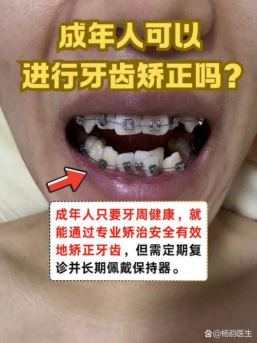 30岁矫正牙齿还来得及吗 成年人正畸必看