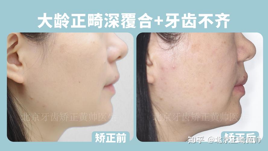 45岁做深覆合矫正大概多少钱？费用明细全公开