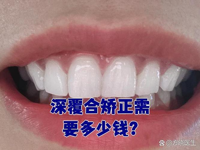 覆盖牙齿矫正_45岁矫正深覆合牙齿要多少钱_矫正覆合牙套多少钱