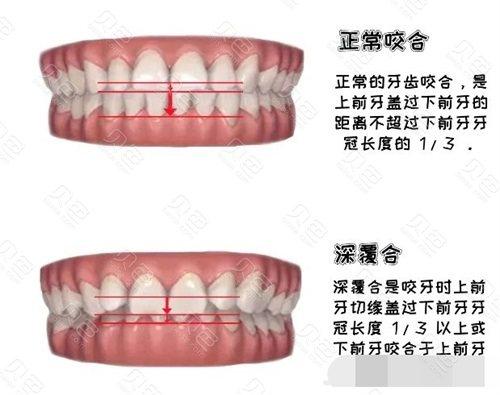 覆盖牙齿矫正_矫正覆合牙套多少钱_45岁矫正深覆合牙齿要多少钱