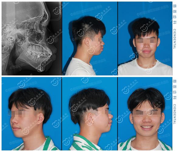 深圳罗湖骨性龅牙隐形矫正能行吗？方案详解