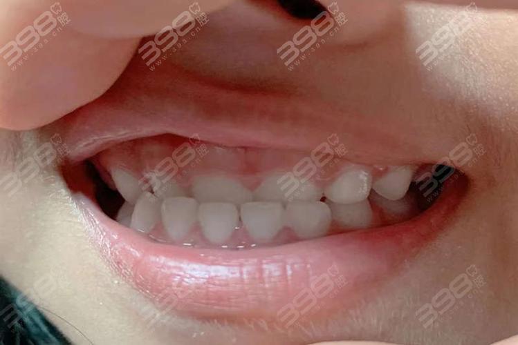 深圳儿童地包天最佳矫正年龄_深圳治疗地包天哪家医院好_儿童地包天矫正医院
