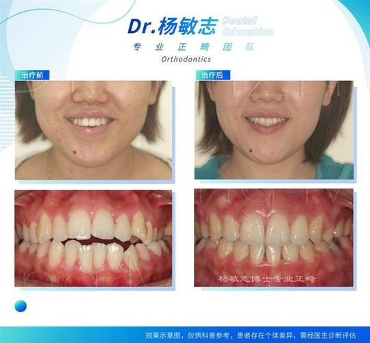 24岁牙不齐能矫正吗_矫正牙齿整齐后还要多久取牙套_牙齿矫正期间可以取下来吗