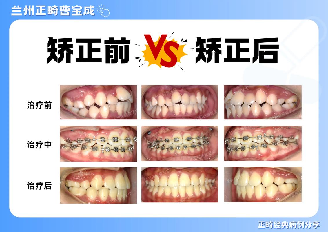 牙齿矫正期间可以取下来吗_矫正牙齿整齐后还要多久取牙套_24岁牙不齐能矫正吗
