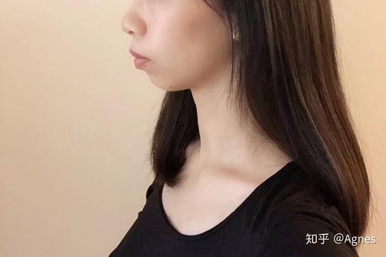 深圳龙岗隐适美矫正周期多久_深圳最厉害的隐适美医生_深圳隐适美矫正医院