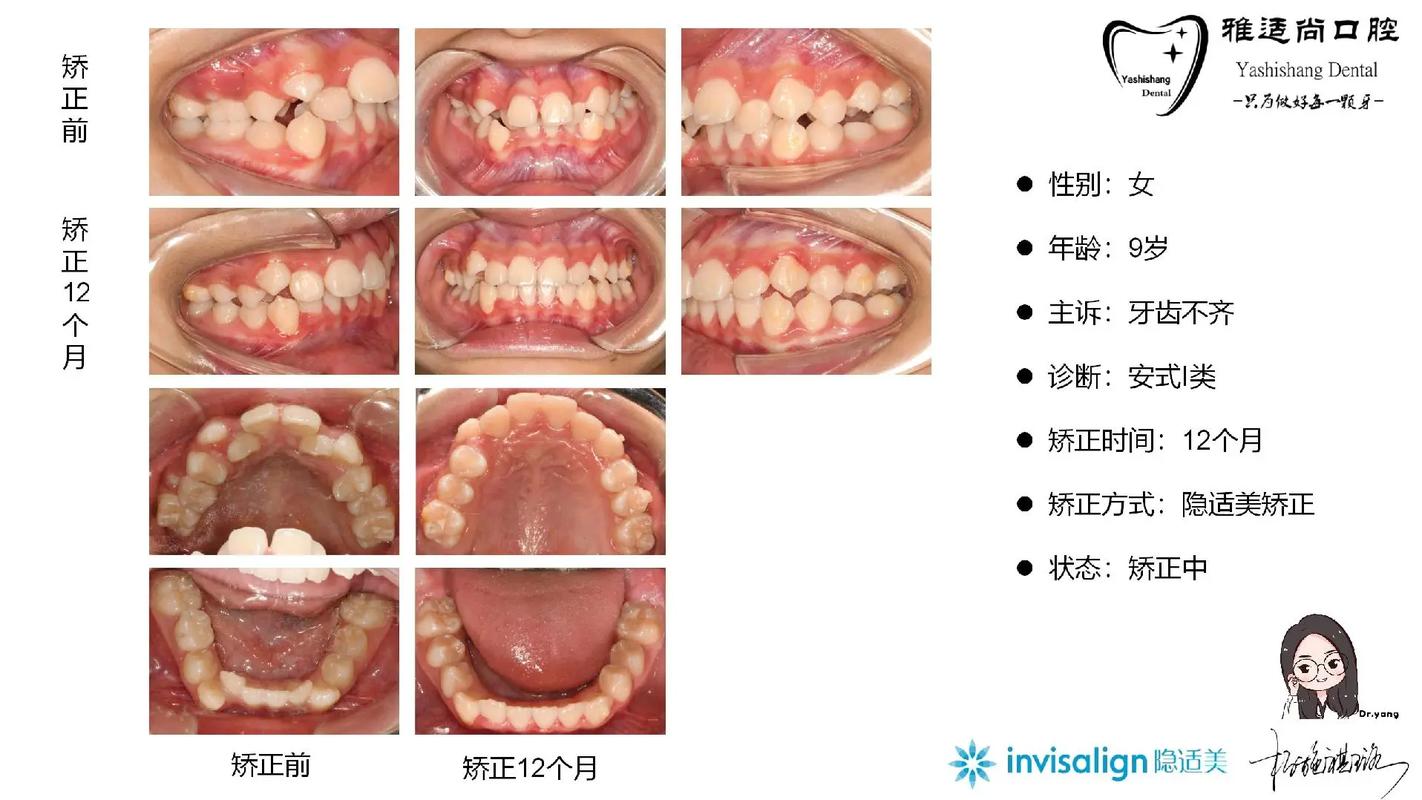 深圳龙岗隐适美矫正周期多久_深圳隐适美矫正医院_深圳最厉害的隐适美医生