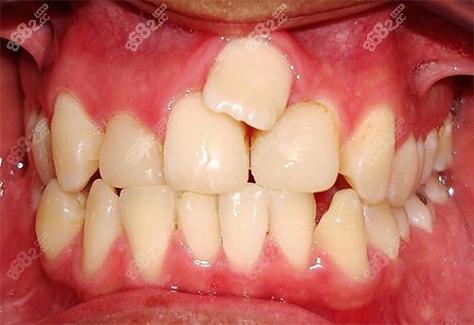 矫正突出门牙可以矫正吗_50岁门牙突出可矫正吗_门牙突出矫正需要多长时间
