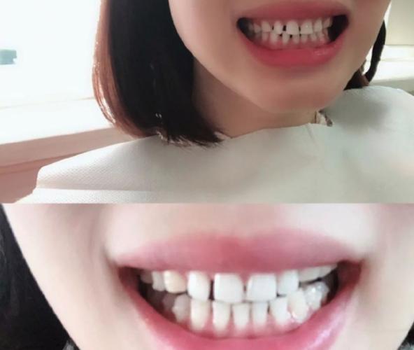 成都钢丝矫正牙齿需要多少钱_牙齿矫正钢丝选哪种更省心_牙齿矫正钢丝每个月都要换吗