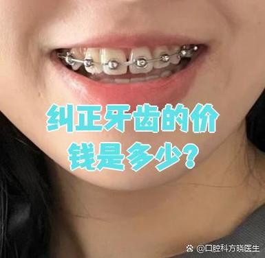 固定牙齿矫正大概需要多少钱_牙齿矫正固定钱需要拔掉吗_牙齿矫正固定钱需要多长时间