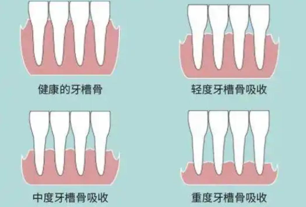 牙能种一颗吗_牙能种吗_60多岁能种牙吗