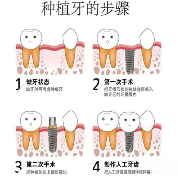 深圳种牙多少钱一颗啊_深圳奥齿泰种植牙优缺点+收费_深圳2021种植牙收费价目表