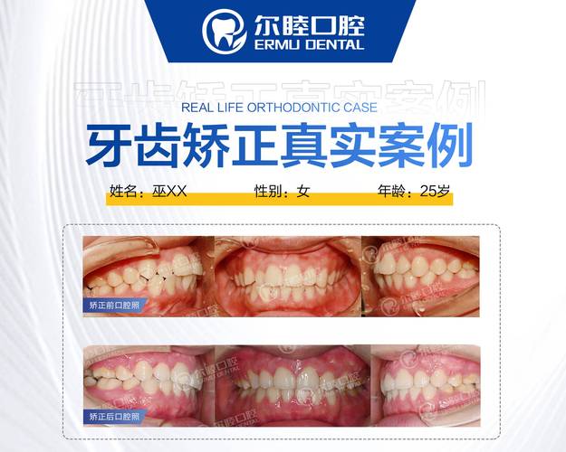 深圳宝安金属自锁托槽矫正哪里好？公立和私立医院怎么选