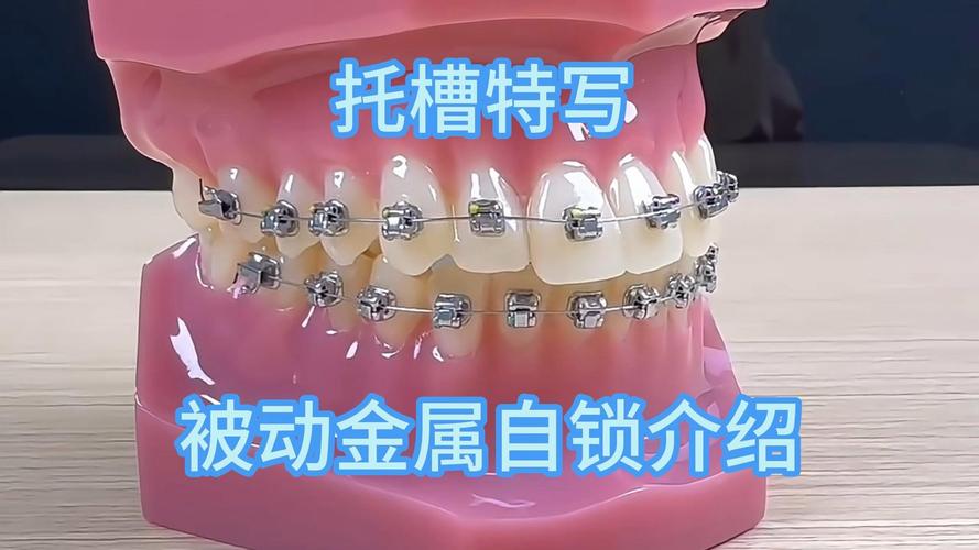 深圳自锁牙套价格_深圳宝安金属自锁托槽矫正医院_深圳宝安区矫正牙齿
