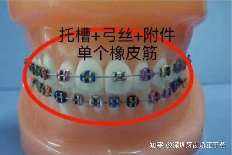 深圳宝安区矫正牙齿_深圳宝安金属自锁托槽矫正医院_深圳自锁牙套价格