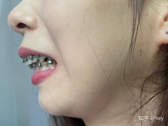 成年人的牙齿怎么矫正_成年牙齿矫正人会变老吗_成年了做牙齿矫正
