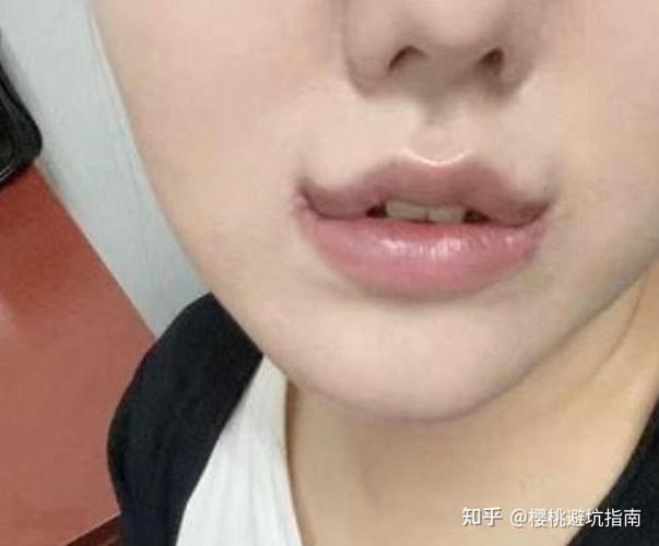 深圳隐形牙套哪家便宜_深圳福田隐形牙齿矫正哪家医生好_深圳隐适美医生排名