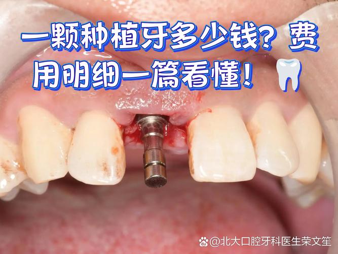 深圳种牙贵不贵？揭秘诺贝尔种植牙门诊真实收费明细