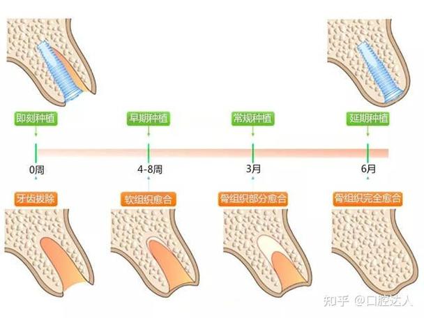 掉3颗牙怎样种植_种植牙掉了_种植的牙掉了怎么办