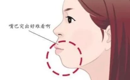 正颌手术前必读：矫正牙齿正颌全过程详解