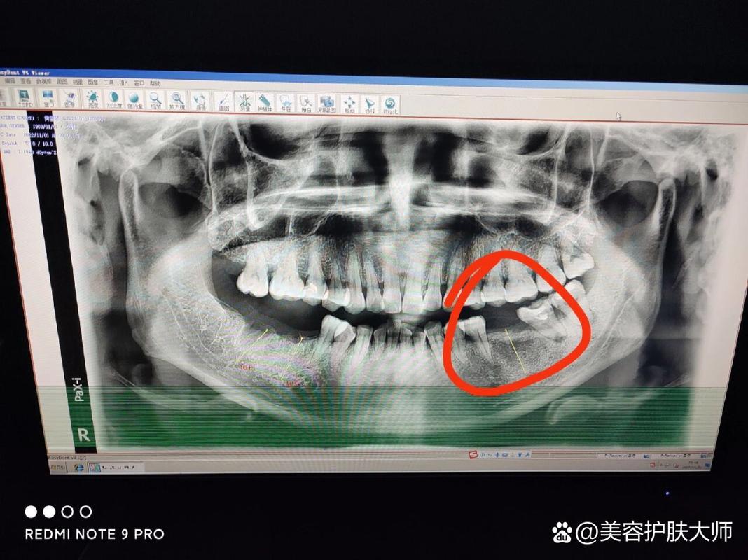 深圳皓圣种植牙医院靠谱吗 真实推荐指南