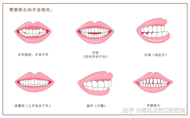 深圳宝安孩子换牙期牙齿歪怎么矫正_深圳宝安区牙齿矫正_牙齿矫正大概要花费多少钱深圳