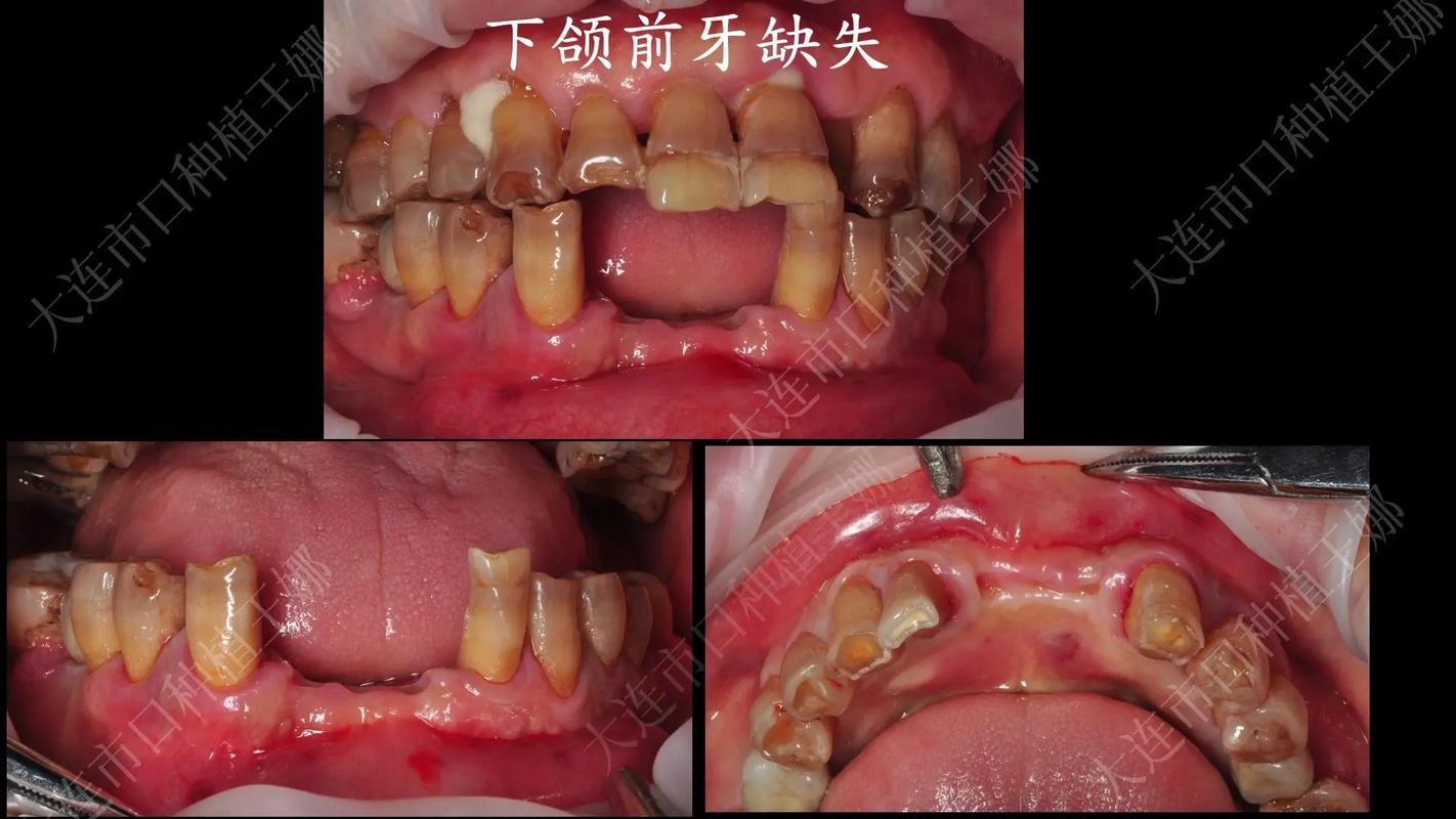 牙齿矫正拔下门牙_拔掉门牙矫正牙齿_牙齿矫正拔掉门牙会怎么样