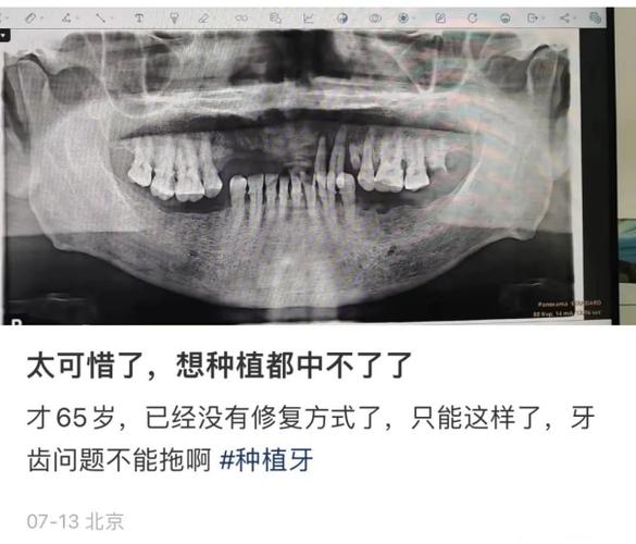 拔掉门牙矫正牙齿_牙齿矫正拔下门牙_牙齿矫正拔掉门牙会怎么样