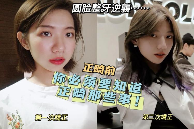23岁还能整牙齿矫正_牙齿矫正以后还会变形吗_牙齿矫正会复原吗