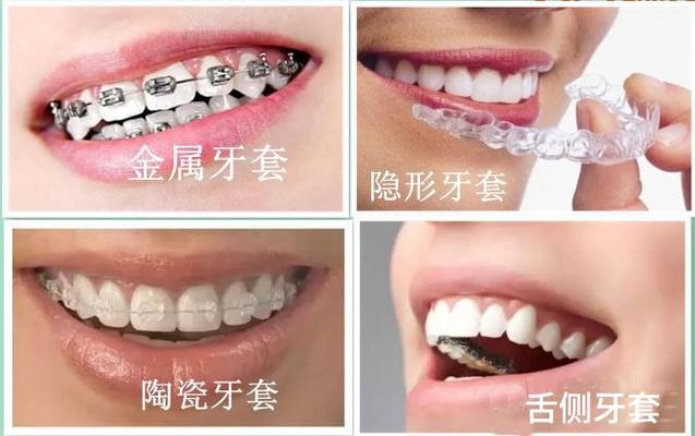 隐形牙齿矫正大概需要多少钱_矫正牙齿隐形矫正_矫正隐形牙齿过程