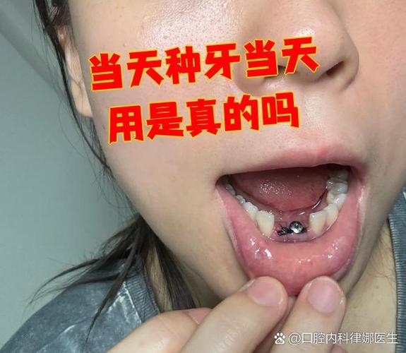 瑞典诺贝尔种植牙价格_瑞典诺贝尔种植牙一颗多少钱_深圳瑞典诺贝尔即刻种植牙