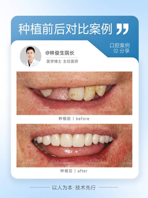 罗湖东门种牙多少钱 2026最新价目表
