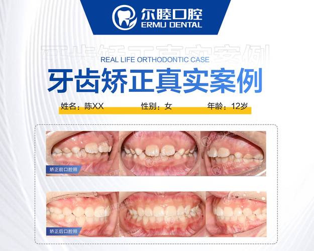 深圳西乡牙齿矫正费用到底要多少钱？2026年最新价格参考