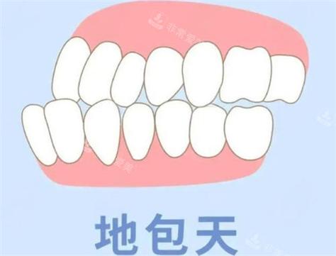 矫正牙齿地包天一般要花多少钱_矫正地包天牙套价格_32岁地包天牙齿矫正费用