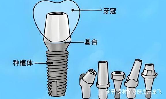 牙齿能镶在种植牙上吗_种植牙能维持多久 2026 最新_牙齿种植能管多少年