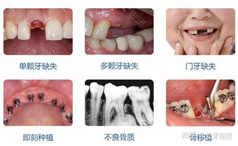 深圳口腔医院种植牙价格表_深圳牙科连锁店前十名_深圳连锁口腔种植牙报价对比