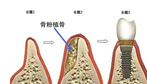 种牙时间流程_的种牙时间_种牙最佳时机