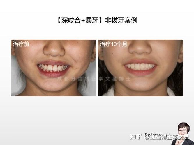 22岁牙齿矫正多少钱_牙齿矫正钱要一次性付完吗_牙齿矫正钱是一次付清吗