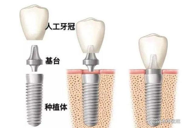 集采种牙和自费种牙到底差在哪