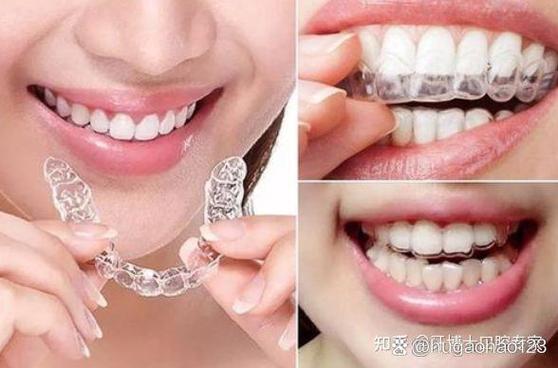 隐适美与时代天使区别_深圳矫正隐适美和时代天使差价_隐适美和时代天使价格多少
