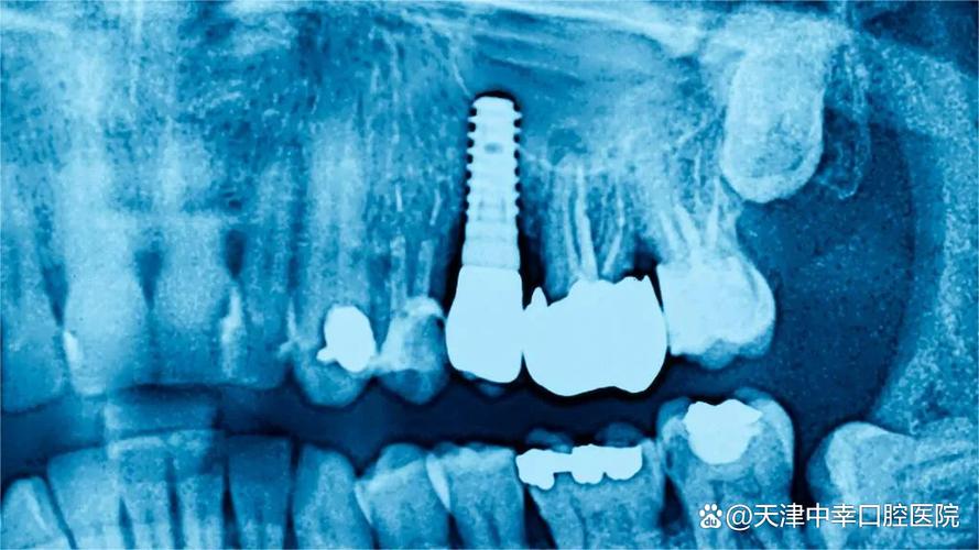 罗湖医院种一颗牙要多少钱_深圳罗湖骨量不足全口种牙费用_罗湖种牙哪里最好