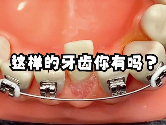 8岁小孩牙齿歪了能矫正吗 家长别错过最佳时机