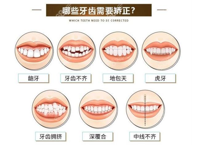 深圳治疗地包天哪家医院好_深圳儿童地包天最佳矫正年龄_儿童地包天矫正医院
