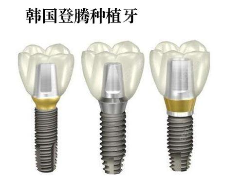 牙种植种植牙价格_深圳南山韩国登腾种植牙价格_登腾骨粉价格