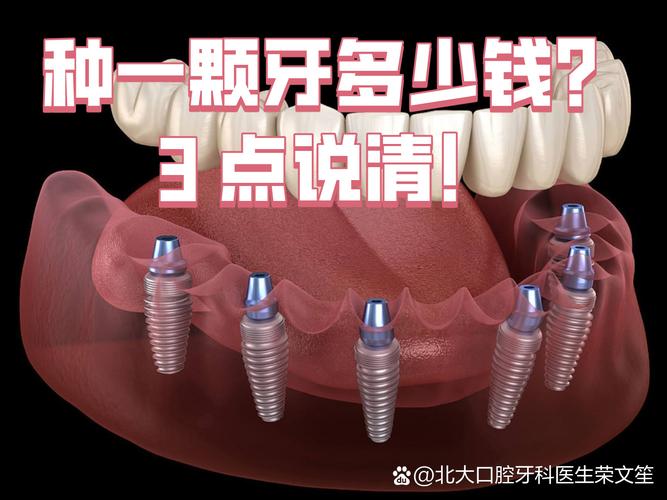 沈阳种植牙哪家便宜_沈阳种植牙齿医院排名_沈阳种植牙 2026 价格 单颗 3000-5200 元