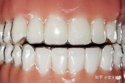 成人隐形矫正牙齿案例_隐形成人牙齿矫正牙套能用多久_成人矫正牙齿隐形牙套