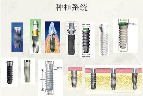 种植国产牙和进口牙的区别_国产种植牙好还是进口的好_种植牙不同品牌价格对比 国产 / 韩系 / 欧美