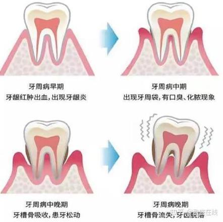 三十岁还能整牙吗？成人牙齿矫正必知真相