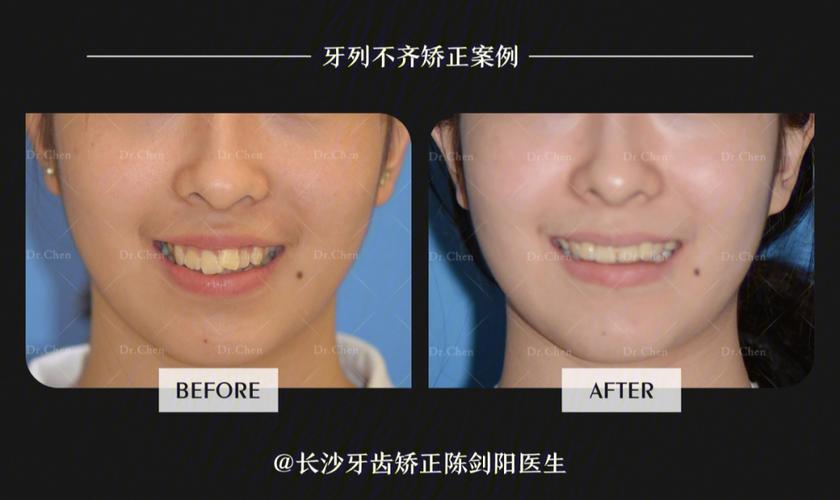 拔门牙矫正牙齿会松动吗？正畸医生说出大实话